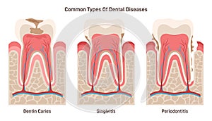 Dental disease set. Dentin caries, gingivitis and periodontitis. Oral cavity photo