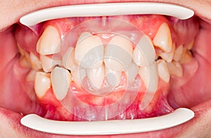 Dental displacement