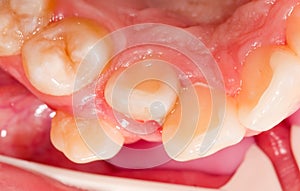 Dental displacement