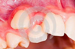 Dental displacement photo