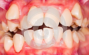 Dental displacement photo