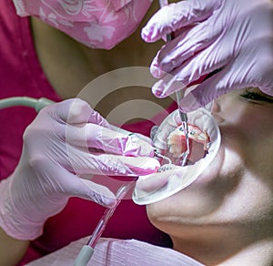 Dental examination. Patient with braces and cheek retractor