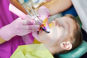 Dental filing of child tooth by ultraviolet light