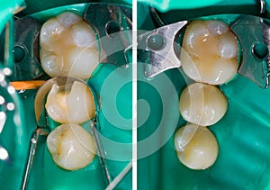 Dental filling comparison, before - after photo