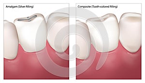 Dental Filling Procedure. Amalgam Silver filling and Composite Tooth colored filling. Dental restorations