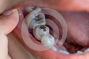 Dental fillings photo