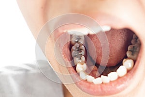 Dental fillings and dental caries photo