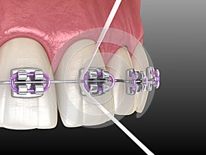 Dental floss cleaning braces process. Medically accurate 3D illustration of oral hygiene