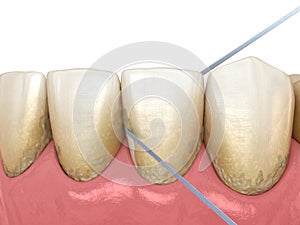 Dental floss cleaning process. Medically accurate dental 3D illustration