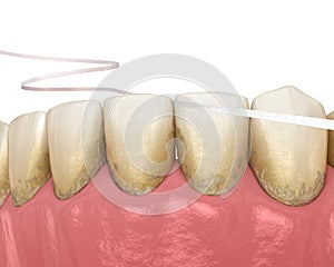 Dental floss cleaning process. Medically accurate dental 3D illustration