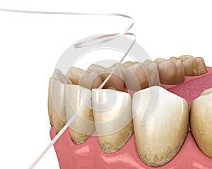 Dental floss cleaning process. Medically accurate dental 3D illustration