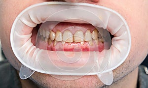 Dental fluorosis