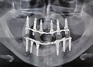 Dental guided surgery photo