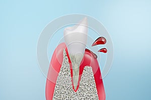 Dental Gum disease, bleeding at root of teeth