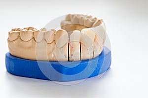 Dental gypsum model in dentist laboratory office - close-up. Gypsum Dentures with porcelain teeth isolated on white background