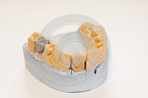 Dental gypsum model in dentist laboratory office - close-up. Gypsum Dentures with porcelain teeth isolated on white background