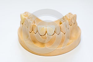 Dental gypsum model in dentist laboratory office - close-up. Gypsum Dentures with porcelain teeth isolated on white background