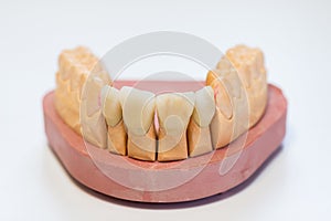 Dental gypsum model in dentist laboratory office - close-up. Gypsum Dentures with porcelain teeth isolated on white background