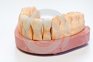 Dental gypsum model in dentist laboratory office - close-up. Gypsum Dentures with porcelain teeth isolated on white background