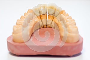 Dental gypsum model in dentist laboratory office - close-up. Gypsum Dentures with porcelain teeth isolated on white background