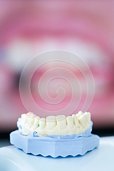 Dental gypsum mold