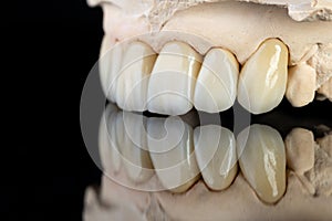 Dental health care. Ceramic zirconium in final version. Close up dental zircon ceramic crowns on black background photo