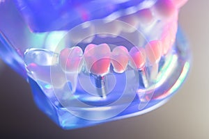 Dental healthy teeth implants