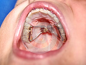 Dental hyrax braces in a young boy mouth. Teen with braces on his teeth.