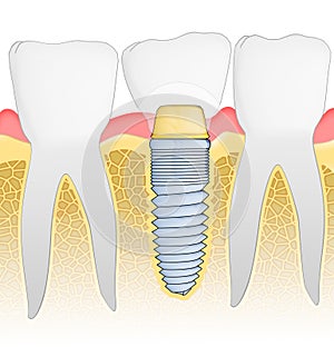 Dental Implant