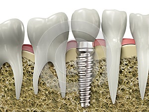 De muy alta resolución de la representación 3d de un implante dental.