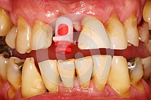 DENTAL IMPLANT