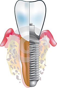 Zubní implantát 