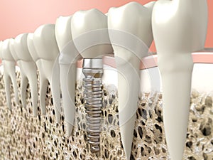 Dental implant