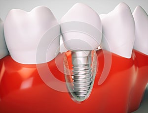 Dental implant - 3d rendering