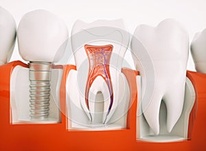 Dental implant - 3d rendering