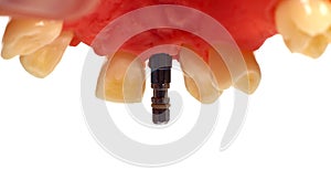 Dental implant