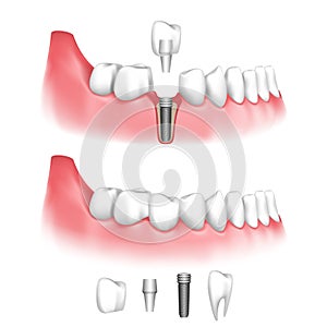 Dental implant