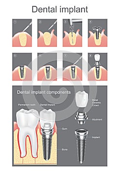 Dental implant.