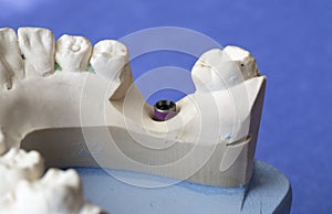 A dental implant artificial mold