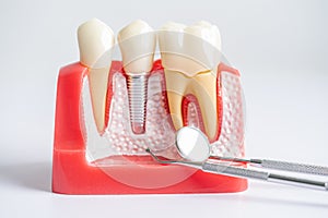 Dental implant, artificial tooth roots into jaw, root canal of dental treatment, gum disease, teeth model for dentist studying