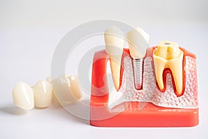 Dental implant, artificial tooth roots into jaw, root canal of dental treatment, gum disease, teeth model for dentist studying