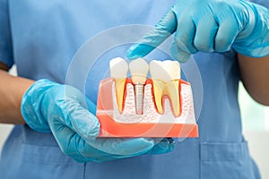 Dental implant, artificial tooth roots into jaw, root canal of dental treatment, gum disease, teeth model for dentist studying