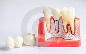 Dental implant, artificial tooth roots into jaw, root canal of dental treatment, gum disease, teeth model for dentist studying