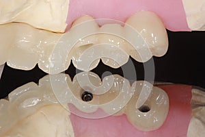 A dental implant bridge with reflection of occlusal hole photo