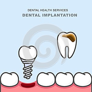 Dental implant instead of carious tooth - teeth prosthetics