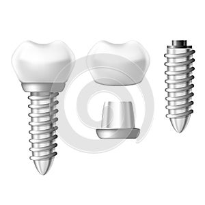 Dental implant component parts - tooth denture components