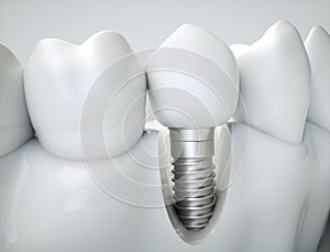 Impianto dentale  un'immagine tridimensionale creata utilizzando un modello computerizzato 