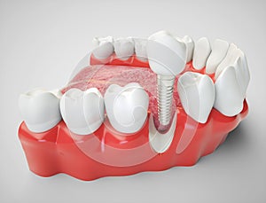 Impianto dentale  un'immagine tridimensionale creata utilizzando un modello computerizzato 