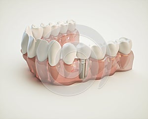 Dental implant - 3d rendering photo