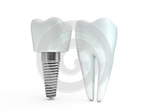 Dental implant dentist, tooth layout, plastics, man, teeth, treatment. 3D photo